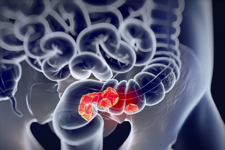 Mắc hai loại ung thư đường tiêu hóa