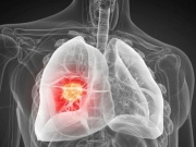 Phát hiện nguyên nhân gây ung thư phổi chưa từng biết