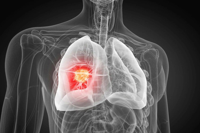Một cơ chế viêm nhiễm chưa từng được biết đến trước đây có thể là thủ phạm khiến một loại ung thư phổi trở nên nguy hiểm hơn - Ảnh minh họa: SCITECH DAILY