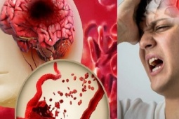 Xuất huyết não thường xảy ra vào 10 'thời điểm' nguy hiểm này: Những dấu hiệu nên đến viện ngay lập tức!