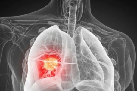 Phát hiện nguyên nhân gây ung thư phổi chưa từng biết