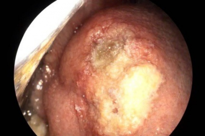 Vết loét nhỏ tưởng vô hại, hóa ung thư lưỡi