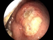 Vết loét nhỏ tưởng vô hại, hóa ung thư lưỡi