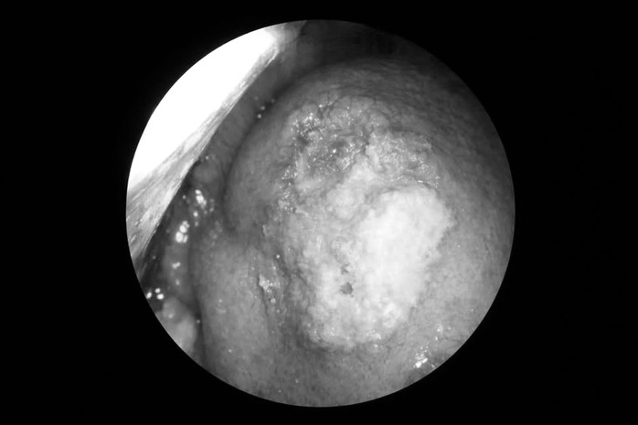 Tổn thương vùng lưỡi của bệnh nhân ung thư lưỡi