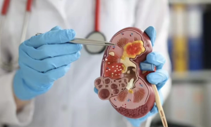 Việc liên tục xử lý nồng độ natri cao khiến hệ thống lọc máu phải làm việc ở cường độ tối đa. Ảnh minh họa: Times of India