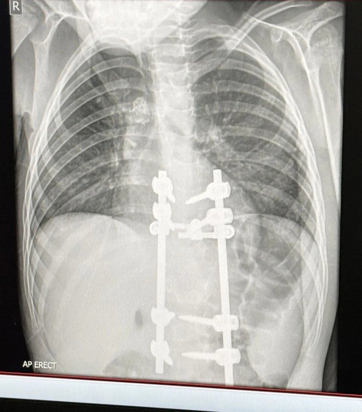 Kết quả X-quang của Elliot sau phẫu thuật. (Ảnh: Kennedy News)
