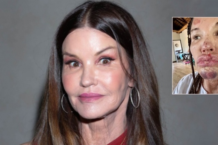 Cựu siêu mẫu công bố ảnh mặt biến dạng sau tai nạn ở show truyền hình