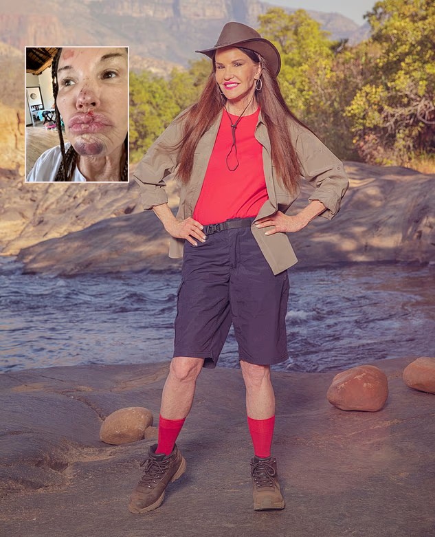 Janice Dickinson bị tai nạn khi tham gia show truyền hình thực tế 'I’m A Celebrity' ở Nam Phi.