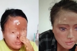 Người phụ nữ tự vẽ mắt, gắn mũi sau bi kịch bị chồng cũ tạt axit