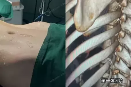 Xu hướng bẻ xương sườn để có vòng eo con kiến