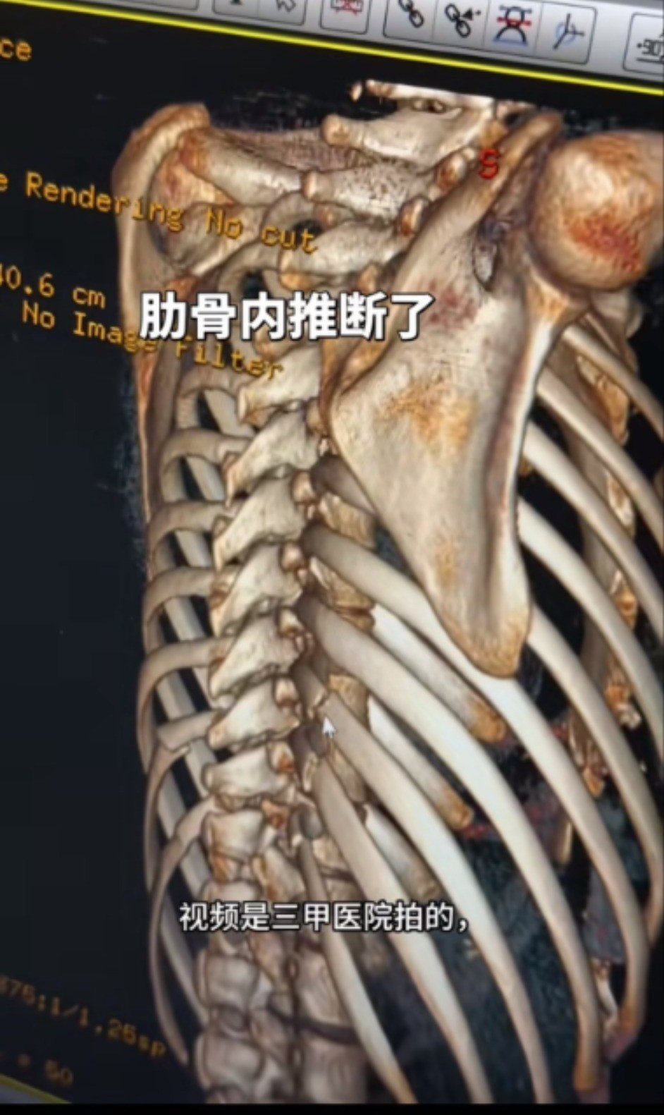 Để có được vòng eo nàng tiên cá, khách thẩm mỹ phải chấp nhận bẻ xương sườn, thu hẹp khoang bụng.