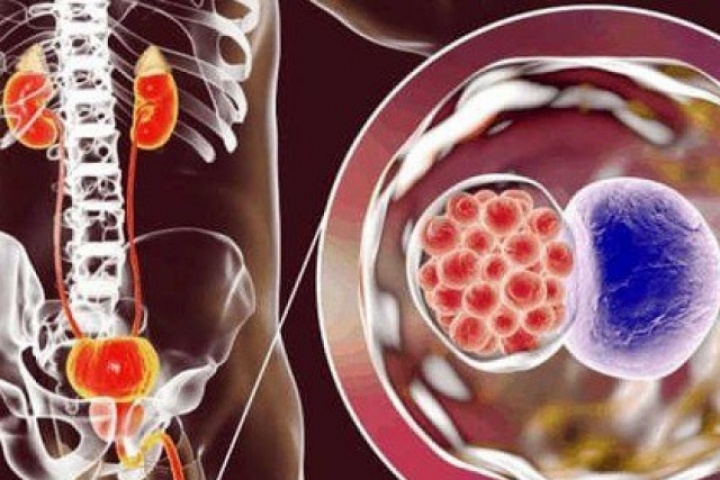 3 bệnh lây truyền qua đường tình dục làm tăng nguy cơ ung thư cổ tử cung