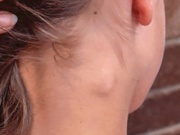 3 bất thường ở cổ cảnh báo ung thư, hãy đi khám bác sĩ ngay lập tức