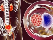 3 bệnh lây truyền qua đường tình dục làm tăng nguy cơ ung thư cổ tử cung