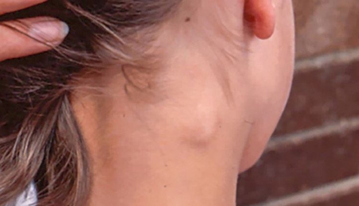 Xuất hiện khối u hoặc hạch bất thường ở cổ, cần lưu ý.