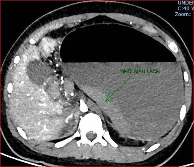 Hình ảnh chụp CT ổ bụng cho thấy dạ dày giãn lớn, xoắn bất thường; kèm tổn thương nhồi máu lách và viêm tụy trên nền ca bệnh hiếm, diễn biến đặc biệt nặng - Ảnh Bệnh viện cung cấp