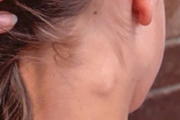 3 bất thường ở cổ cảnh báo ung thư, hãy đi khám bác sĩ ngay lập tức