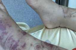 Chuyên gia cảnh báo về một căn bệnh nguy hiểm, lây lan nhanh, tỉ lệ tử vong cao