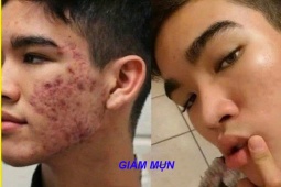 Tin tức sức khỏe - Đàn ông con trai bị mụn: Chấm dung dịch này mỗi tối là sạch sẽ, không cần đi Spa với bôi kem như con gái