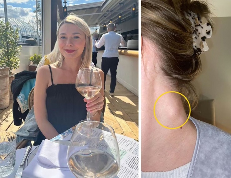 Hollie Thursby có những cơn đau sau khi uống rượu và phát hiện khối u ở cổ. Ảnh: Mirror