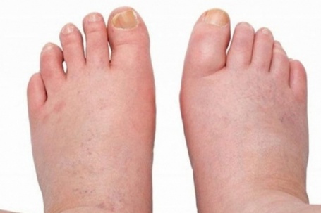 Bàn chân xuất hiện những dấu hiệu này, thận có thể đang 'kêu cứu'