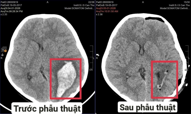 Hình ảnh vị trí xuất huyết do vỡ dị dạng mạch máu não ở bệnh nhi trước và sau phẫu thuật