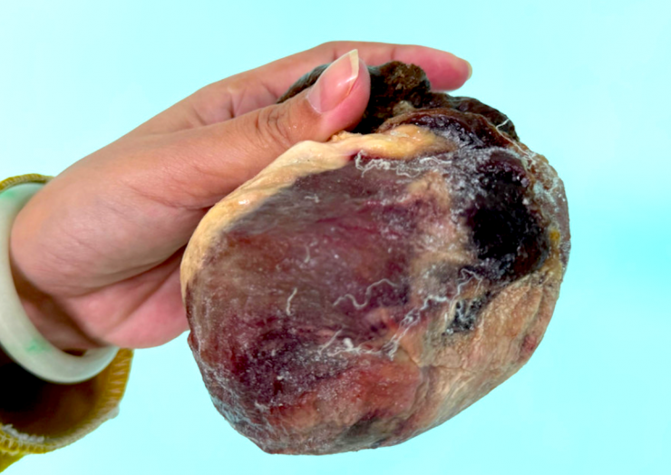 Túi mật chứa vật thể lạ nghi là ngưu hoàng của ông Hùng.