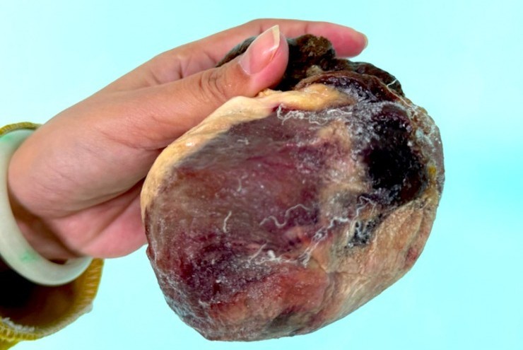 Mổ thịt con bò chỉ ngủ đứng, phát hiện vật thể nghi là ngưu hoàng quý hiếm