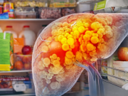 Hai vợ chồng cùng mắc ung thư gan: Cảnh giác 4 loại thực phẩm để lâu trong tủ lạnh