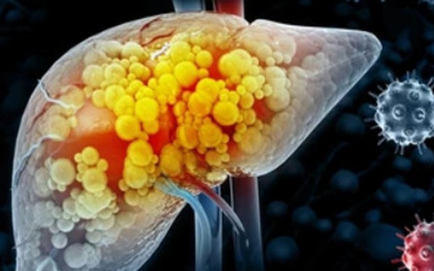 Ung thư gan. Ảnh minh họa