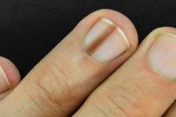 Móng tay nổi sọc dọc báo động nguy hiểm? Đừng chủ quan nếu thấy 4 đặc điểm này