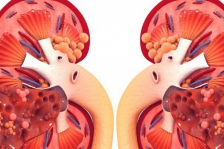 Món ăn rẻ tiền quen thuộc trong bữa cơm Việt, nhưng người bệnh suy thận được khuyến cáo không nên ăn