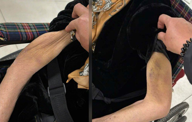 Tay cụ bà bị thâm tím diện rộng.