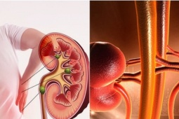 Suy thận tiến triển rất nhanh: 4 dấu hiệu cảnh báo cho người tiểu đường