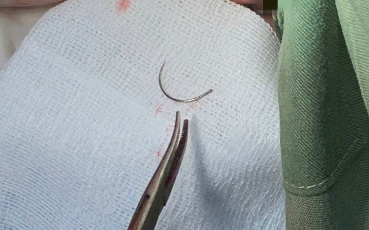 Sau 11 năm đoạn kim khâu bị gãy được lấy ra khỏi cơ thể người phụ nữ.