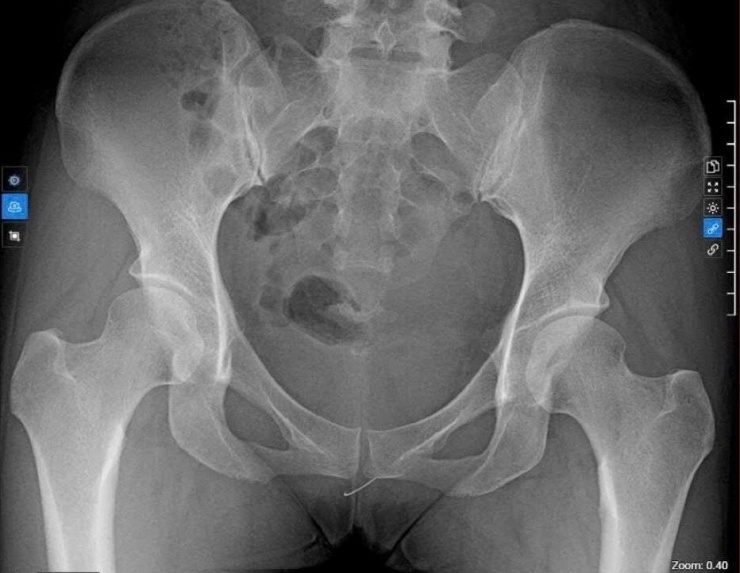 Chụp X-Quang, phát hiện đoạn kim gãy nằm ở tầng sinh môn.