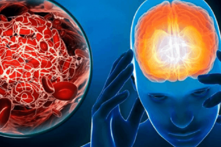 Đột quỵ não giai đoạn sớm không phải đau đầu, mà là 4 dấu hiệu này