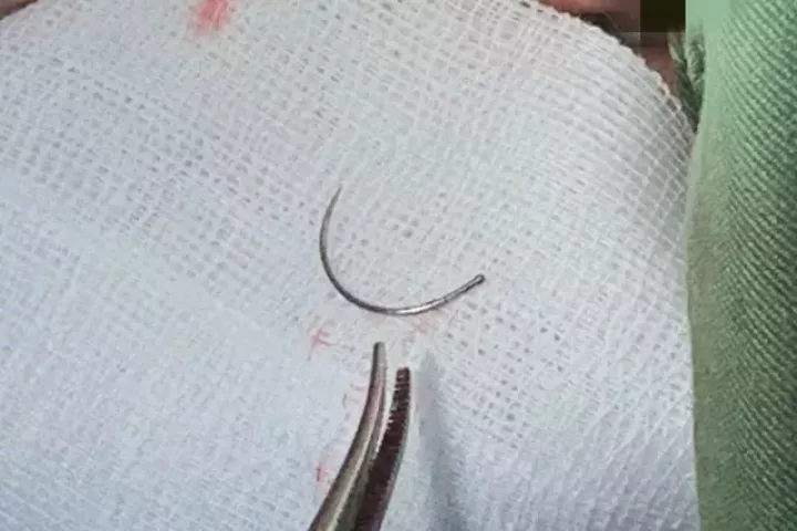 Kim khâu bị ‘bỏ quên’ trong cơ thể người phụ nữ suốt 11 năm