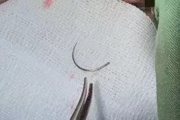 Kim khâu bị ‘bỏ quên’ trong cơ thể người phụ nữ suốt 11 năm