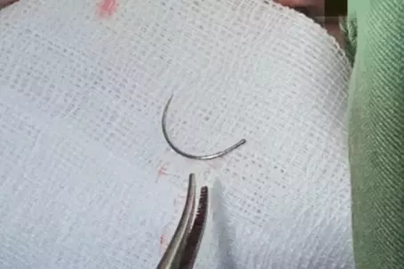 Kim khâu bị ‘bỏ quên’ trong cơ thể người phụ nữ suốt 11 năm