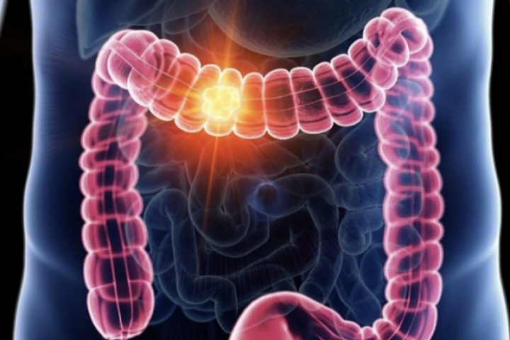 8 dấu hiệu cảnh báo sớm ung thư đại trực tràng dễ bị ngó lơ