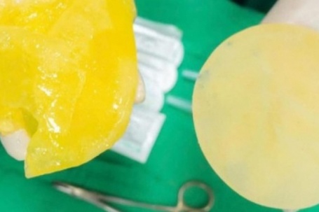 Phụ nữ đã "trùng tu" vòng 1 có nên chơi pickleball?