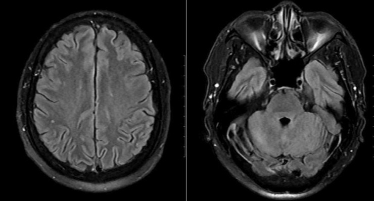 Tổn thương phát hiện trên phim chụp MRI của bệnh nhân. Ảnh: BVCC
