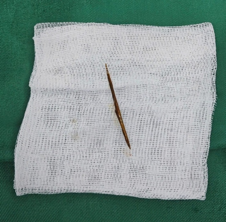 Chiếc tăm tre xuyên thủng ruột bệnh nhân. Ảnh: BVCC