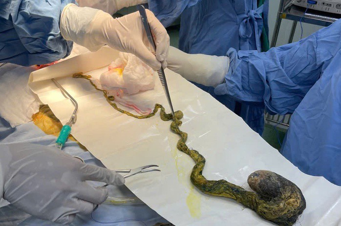 Búi tóc khổng lồ được lấy ra ngoài