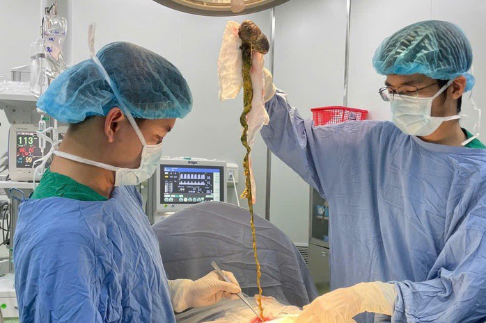 Các bác sĩ Bệnh viện Phụ sản – Nhi Đà Nẵng tiến hành ca phẫu thuật, lấy búi tóc trong bụng một bé trai