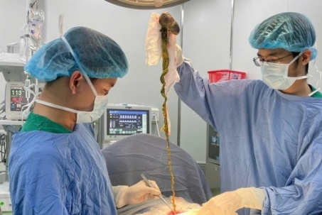 Bé trai phải lên bàn mổ vì ăn tóc, bác sĩ cảnh báo tình trạng y khoa hiếm gặp