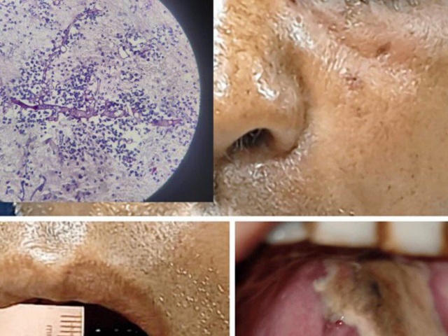 Người đàn ông ở Phú Thọ mắc bệnh tiểu đường bị hôn mê nguy kịch do nấm đen xâm lấn não