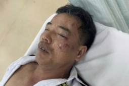 Truy tìm nhóm thanh niên nẹt pô, đánh bảo vệ gãy xương sườn