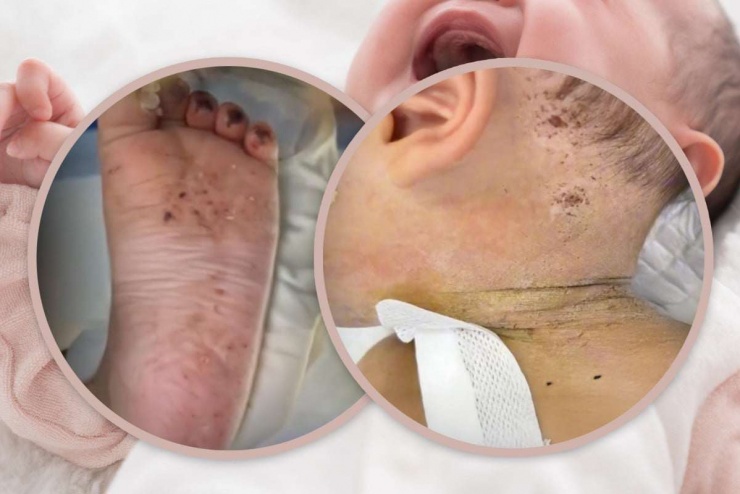 Bé 10 tháng tuổi đã phải trải qua ca phẫu thuật hết sức thận trọng để lấy một phần kim bị gãy nằm dưới da. Ảnh: QQ.com